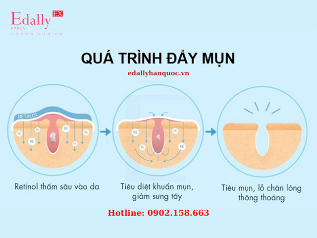 Quá trình đẩy mụn khi skincare