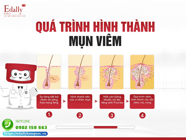 Quá trình hình thành mụn viêm diễn ra như thế nào?