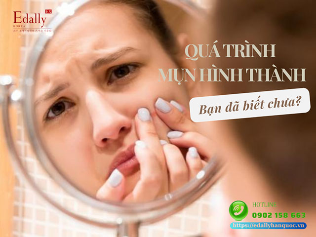 Quá trình hình thành mụn - Nguyên nhân và cách điều trị hiệu quả