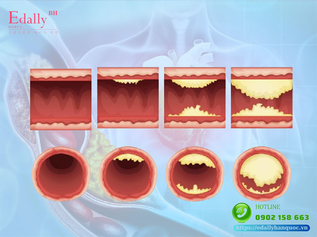 Quá trình hình thành xơ vữa động mạch theo thời gian