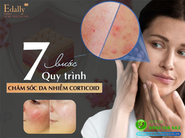 7 bước quy trình chăm sóc da nhiễm Corticoid an toàn và hiệu quả tại nhà