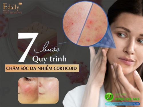 Quy Trình 7 Bước Chăm Sóc Da Nhiễm Corticoid