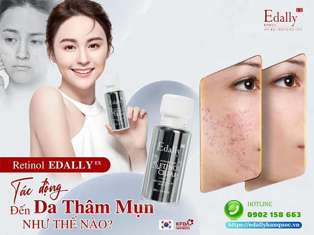 Kem Retinol Edally EX là sản phẩm không thể thiếu trong routine skincare trị viêm mụn ở người trưởng thành