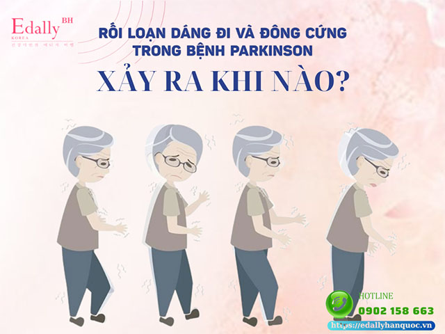 Khi nào thì xảy ra rối loạn dáng đi và đông cứng dáng đi trong bệnh Parkinson?