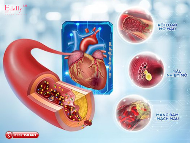 Rối loạn mỡ máu là nguyên nhân hàng đầu gây ra xơ vữa mạch máu dẫn đến đột quỵ và nhồi máu cơ tim