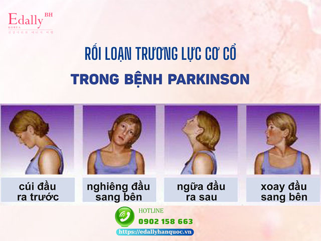 Rối loạn trương lực cơ cổ trong bệnh Parkinson