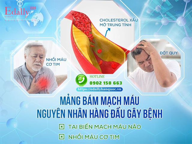 Rối loạn mỡ máu là nguyên nhân gây mảng bám mạch máu dẫn đến đột quỵ