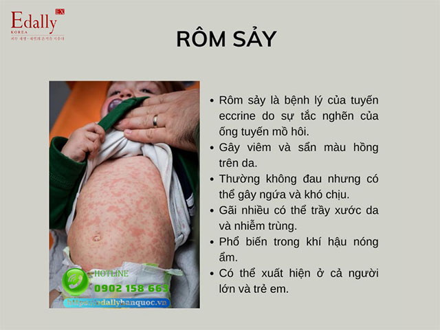 Rôm sảy là bệnh lý ngoài da thường gặp vào mùa hè