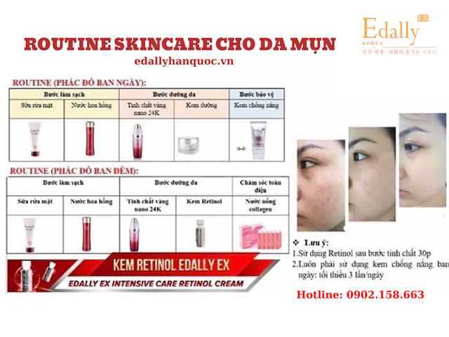 Routine skincare cho da bị mụn