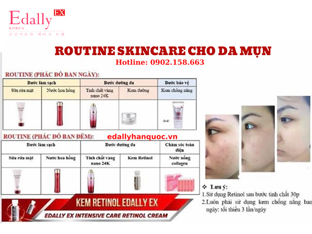 Routine skincare trị mụn hiệu quả nhất tại nhà