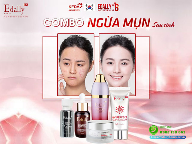 Rroutine skincare điều trị mụn sau sinh an toàn, hiệu quả nhất