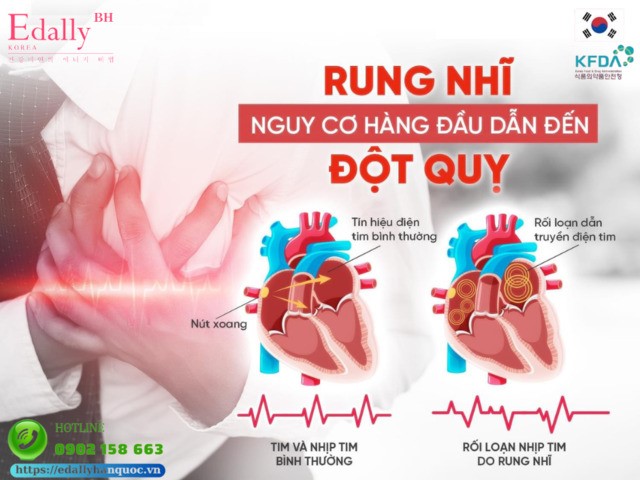 Rung nhĩ (AFIB) - Nguy cơ hàng đầu dẫn đến đột quỵ