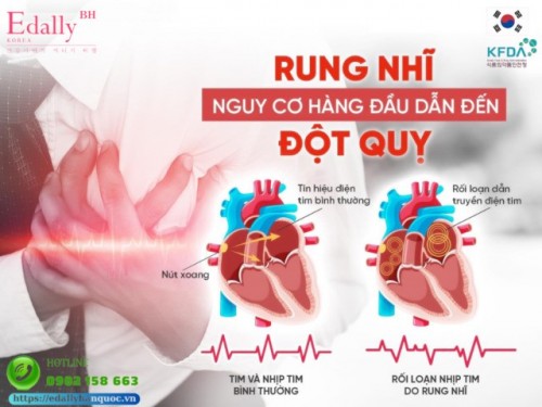 Rung Nhĩ (AFIB) - Nguy Cơ Hàng Đầu Dẫn Đến Đột Quỵ