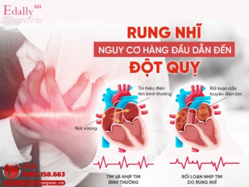 Cập Nhật Rung Nhĩ: Tổng Quan Trên The Lancet Nói Gì?