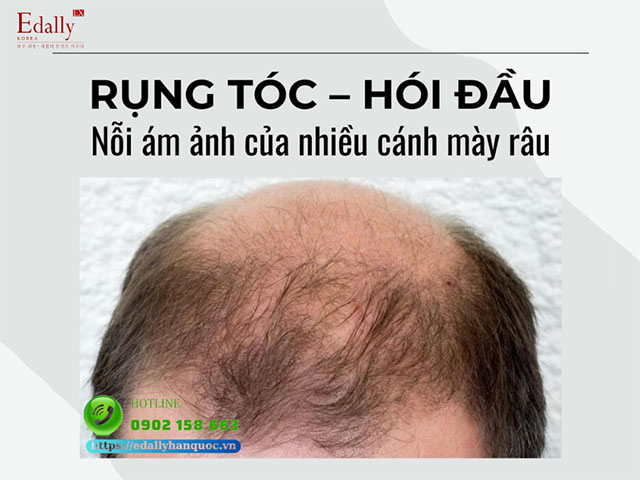 Rụng tóc hói đầu do Androgen - Bệnh lý da liễu phổ biến ở nam giới