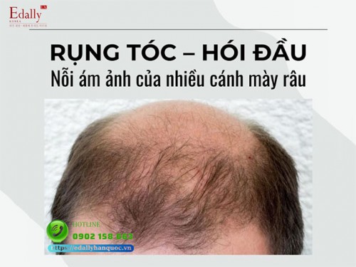 Rụng Tóc Do Androgen - Bệnh Lý Da Liễu Phổ Biến Ở Nam Giới