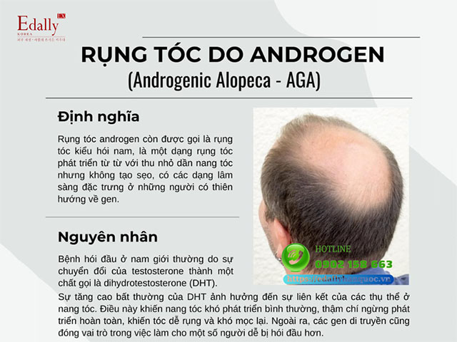 Tìm hiểu về rụng tóc hói đầu do Androgen