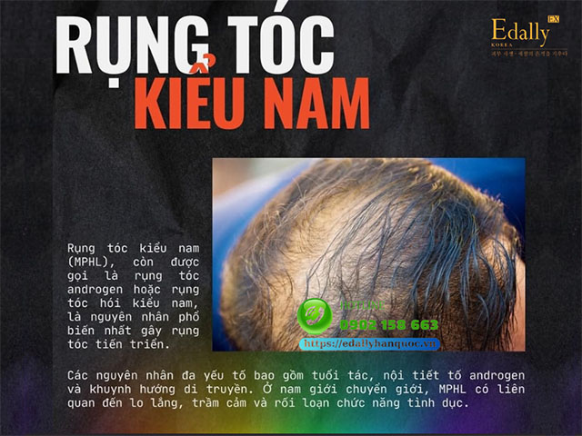 Rụng tóc kiểu nam là bệnh da thường gặp ở người chuyển giới