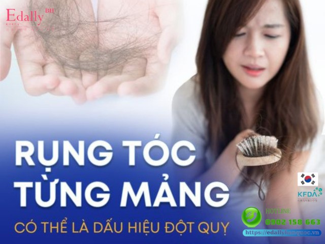 Rụng tóc từng mảng có thể là dấu hiệu đột quỵ