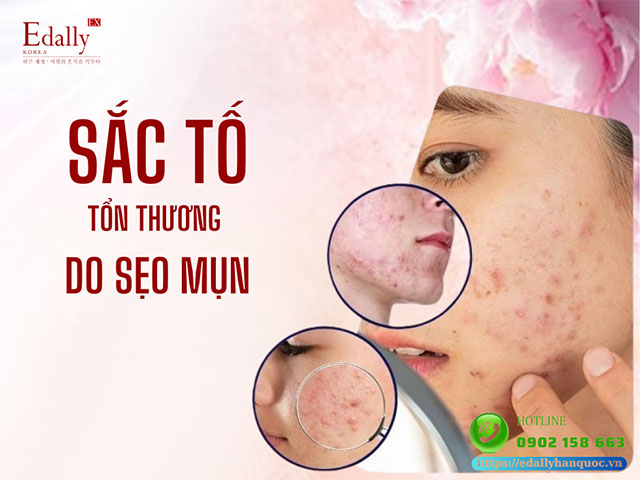 Thay đổi sắc tố của làn da trên khuôn mặt do tổn thương sẹo mụn