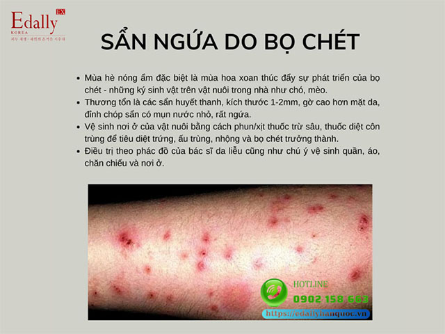 Sẩn ngứa do bọ chét là bệnh lý ngoài da thường gặp vào mùa hè