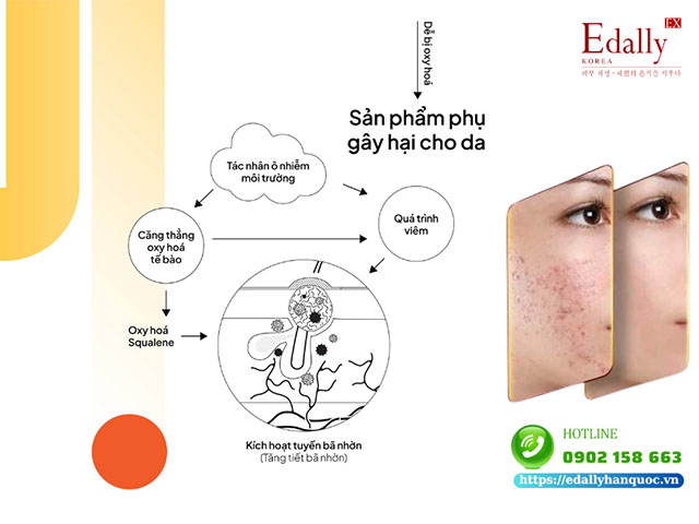 Sử dụng các sản phẩm gây hại làm tăng tiết tuyến bã nhờn và tình trạng mụn trên da
