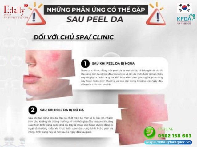 Sau khi peel da bị ngứa và bị đỏ