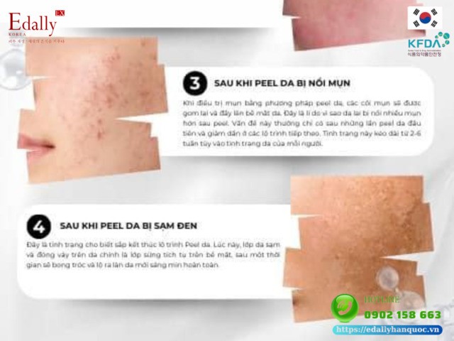 Sau khi peel da bị nổi mụn và sạm đen