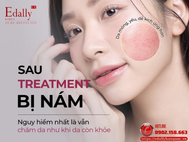 Sau treatment bị nám nguy hiểm nhất vẫn là chăm da như khi da còn khỏe