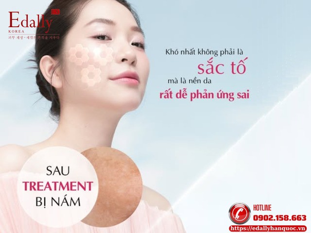 Nám sau treatment - Khó nhất không phải sắc tố mà là nền da rất dễ phản ứng sai