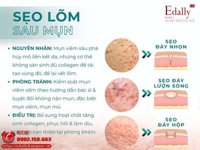 Sẹo lõm sau mụn - Nguyên nhân hình thành và cách phòng ngừa, điều trị Sẹo lõm sau mụn - Nguyên nhân hình thành và cách phòng ngừa, điều trị
