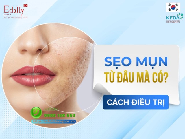 Sẹo mụn do đâu mà có và cách điều trị như thế nào?