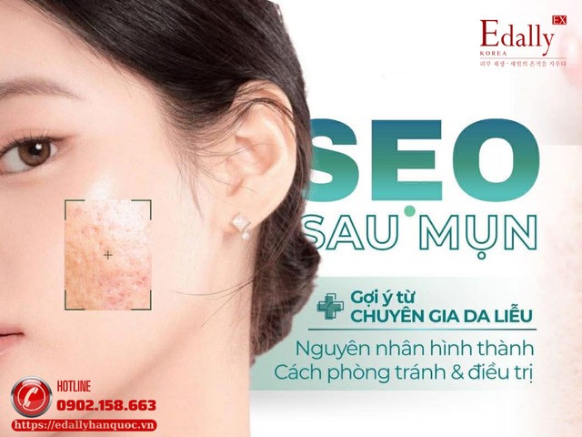 Sẹo sau mụn - Nguyên nhân hình thành và cách phòng ngừa, điều trị Sẹo sau mụn - Nguyên nhân hình thành và cách phòng ngừa, điều trị