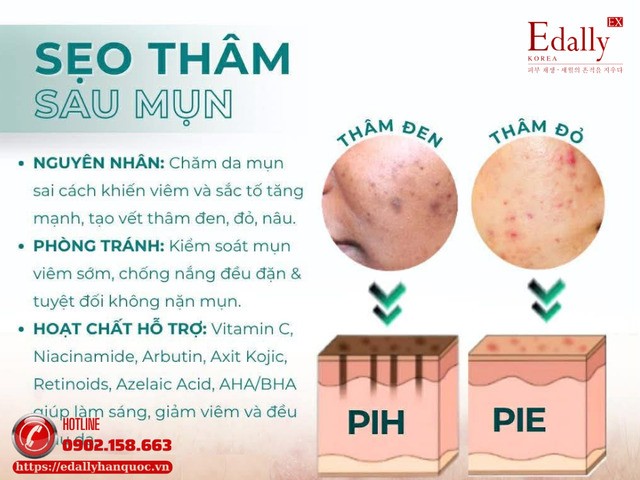 Sẹo thâm sau mụn - Nguyên nhân hình thành và cách phòng ngừa, điều trị Sẹo thâm sau mụn - Nguyên nhân hình thành và cách phòng ngừa, điều trị
