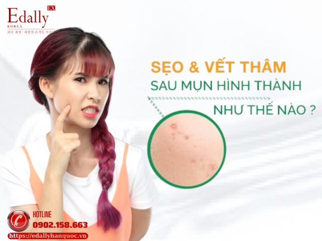 Sẹo và vết thâm do mụn được hình thành như thế nào và làm sao để phòng ngừa và điều trị hiệu quả?