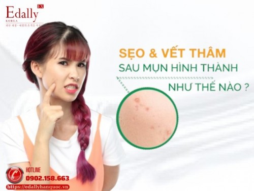 Sẹo Và Vết Thâm Do Mụn - Cách Phòng Ngừa Và Điều Trị