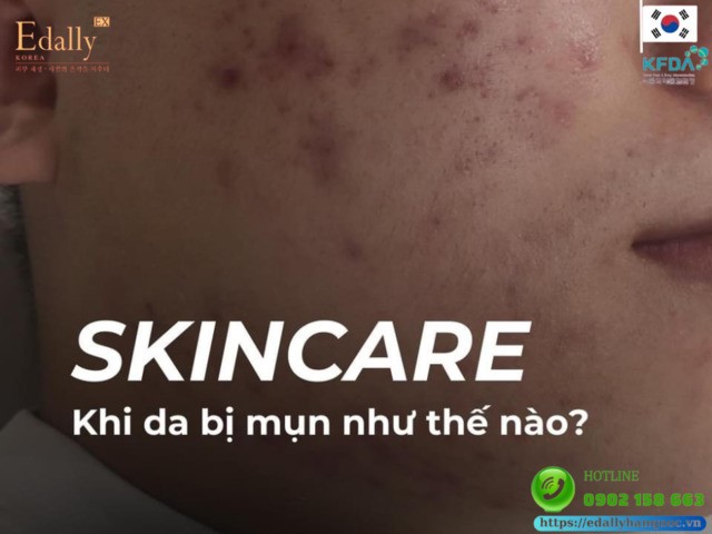 Skincare khi da bị mụn như thế nào?