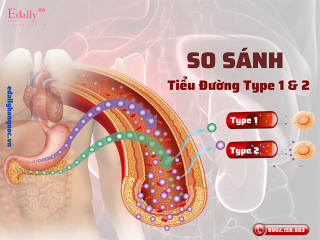 So sánh bệnh tiểu đường type 1 và type 2 giống và khác nhau như thế nào?