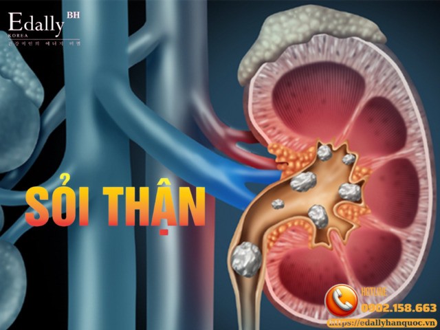 Sỏi thận: Nguyên nhân, triệu chứng, chẩn đoán và cách điều trị