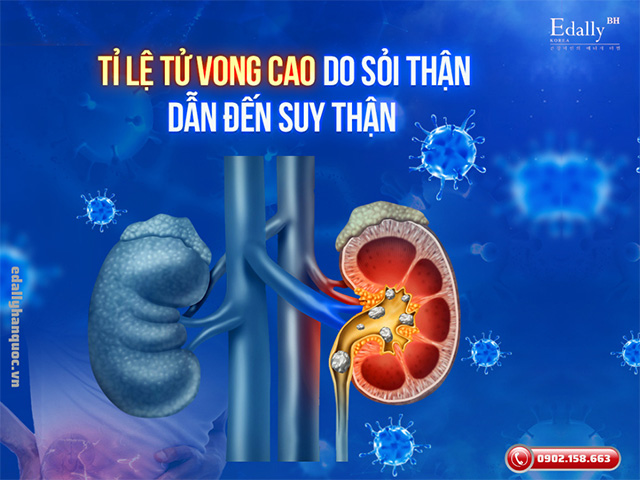 Sỏi thận có thể gây suy thận và dẫn đến tử vong