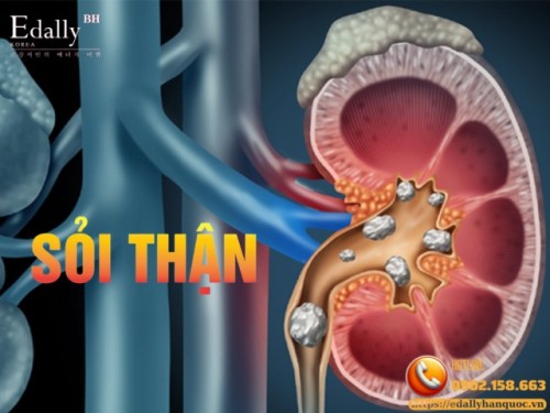Sỏi Thận: Nguyên Nhân, Triệu Chứng, Chẩn Đoán Và Điều Trị