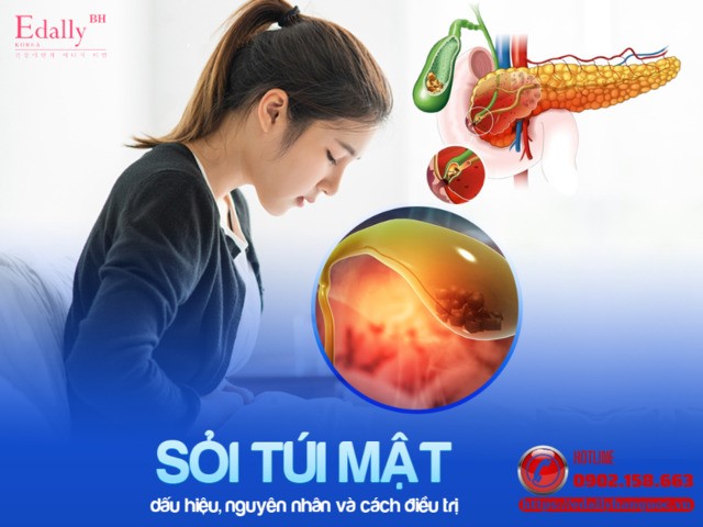 Sỏi túi mật - Nguyên nhân, triệu chứng, cách điều trị và  phòng ngừa hiệu quả