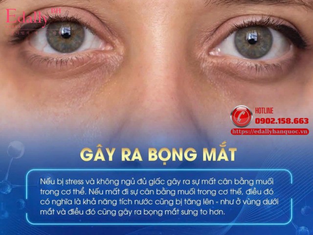 Stress gây ra bọng mắt