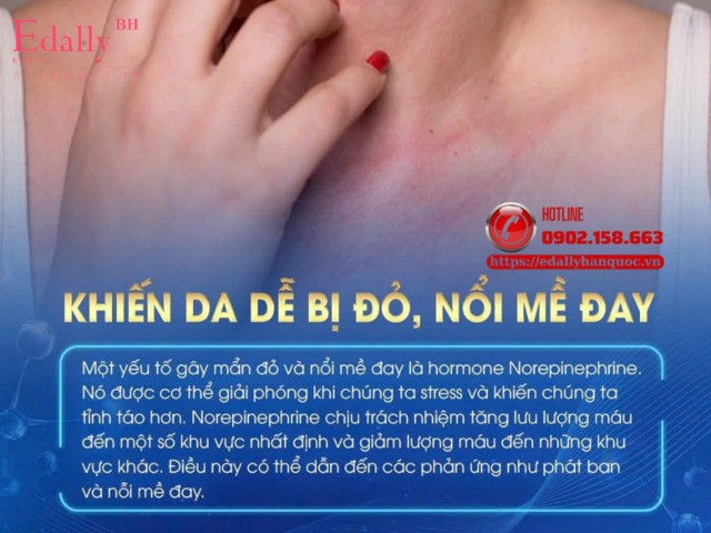 Stress khiến da dễ bị đỏ và nổi mề đay