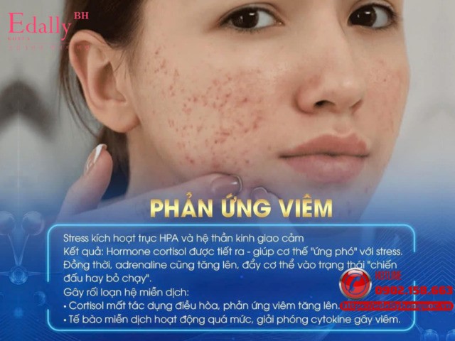 Stress làm tăng phản ứng viêm