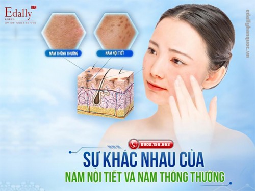 Sự Khác Nhau Của Nám Nội Tiết Và Nám Thông Thường