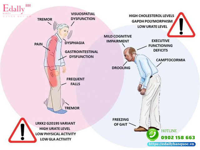 Sự nguy hiểm của rối loạn tư thế ở bệnh Parkinson