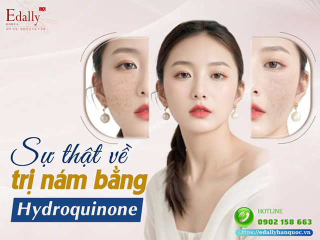 Sự thật về trị nám bằng Hydroquinone có thực sự như mơ?