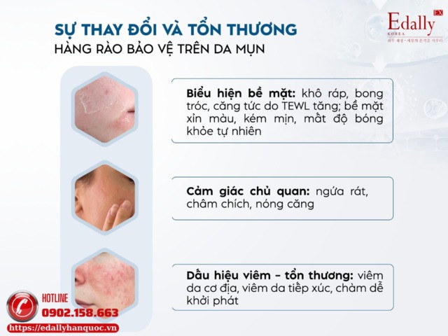 Sự thay đổi và tổn thương hàng rào bảo vệ trên da mụn