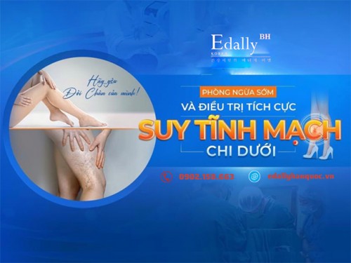 Suy Giãn Tĩnh Mạch Chi Dưới Có Chữa Khỏi Được Không?